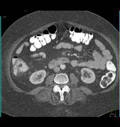 Perforated Appendix With Appendicitis - CTisus CT Scan