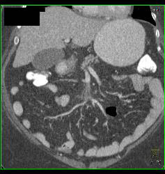 Superior Mesenteric Vein (SMV) Thrombus in Patient With Appendicitis - CTisus CT Scan