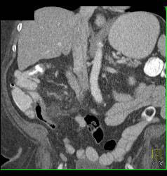 Superior Mesenteric Vein (SMV) Thrombus in Patient With Appendicitis - CTisus CT Scan