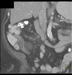 Superior Mesenteric Vein (SMV) Thrombus in Patient With Appendicitis - CTisus CT Scan