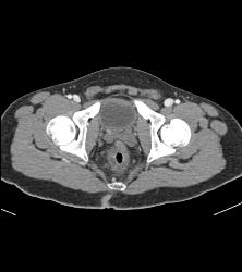 Rectal Varices and Hemmorhoids- See Small Vessels - CTisus CT Scan