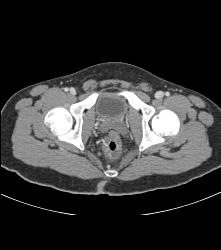 Rectal Varices and Hemmorhoids- See Small Vessels - CTisus CT Scan