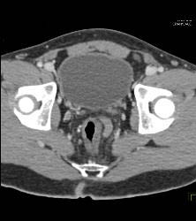 Rectal Varices and Hemmorhoids- See Small Vessels - CTisus CT Scan