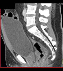 Rectal Varices and Hemmorhoids- See Small Vessels - CTisus CT Scan