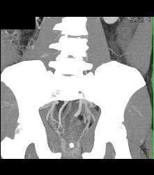 Rectal Varices and Hemmorhoids- See Small Vessels - CTisus CT Scan