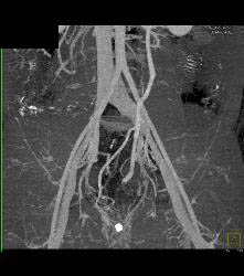 Rectal Varices and Hemmorhoids- See Small Vessels - CTisus CT Scan