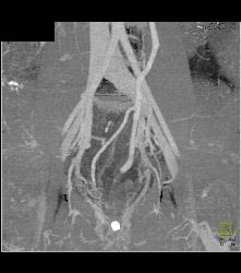 Rectal Varices and Hemmorhoids- See Small Vessels - CTisus CT Scan