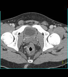 Rectal Varices and Hemmorhoids- See Small Vessels - CTisus CT Scan