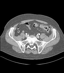 Diverticulitis - CTisus CT Scan