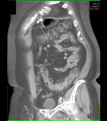 Diverticulitis - CTisus CT Scan