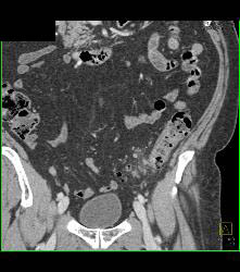 Diverticulitis - CTisus CT Scan