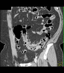 Diverticulitis - CTisus CT Scan