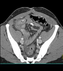 Appendicitis With Abscess - CTisus CT Scan