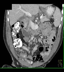 Appendicitis With Abscess - CTisus CT Scan