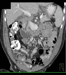 Appendicitis With Abscess - CTisus CT Scan