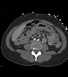 Appendicitis With Abscess - CTisus CT Scan