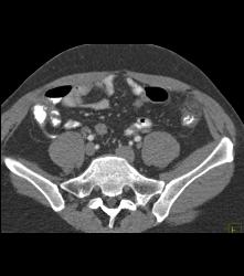 Diverticulitis - CTisus CT Scan