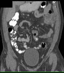 Diverticulitis - CTisus CT Scan