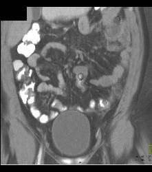 Diverticulitis - CTisus CT Scan