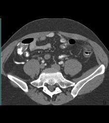 Diverticulitis - CTisus CT Scan