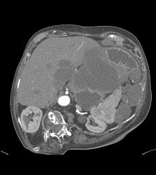 Pseudomyxoma Peritonei (PMP) - CTisus CT Scan