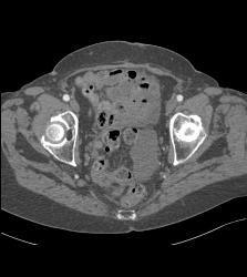 Pseudomyxoma Peritonei (PMP) - CTisus CT Scan