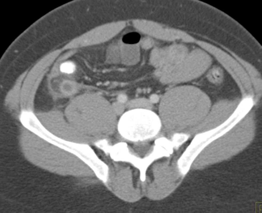 acute appendicitis - CTisus CT Scan