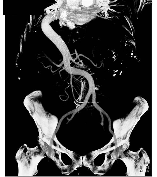 Pseudomyxoma Peritonei (PMP) - CTisus CT Scan