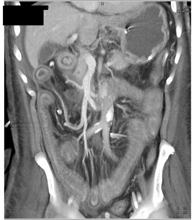 severe enteritis due to chemotherapy - CTisus CT Scan