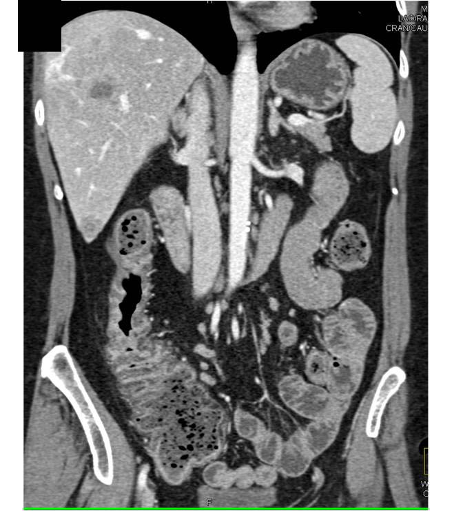 Carcinoma of the Ascending Colon with Liver Metastases - CTisus CT Scan