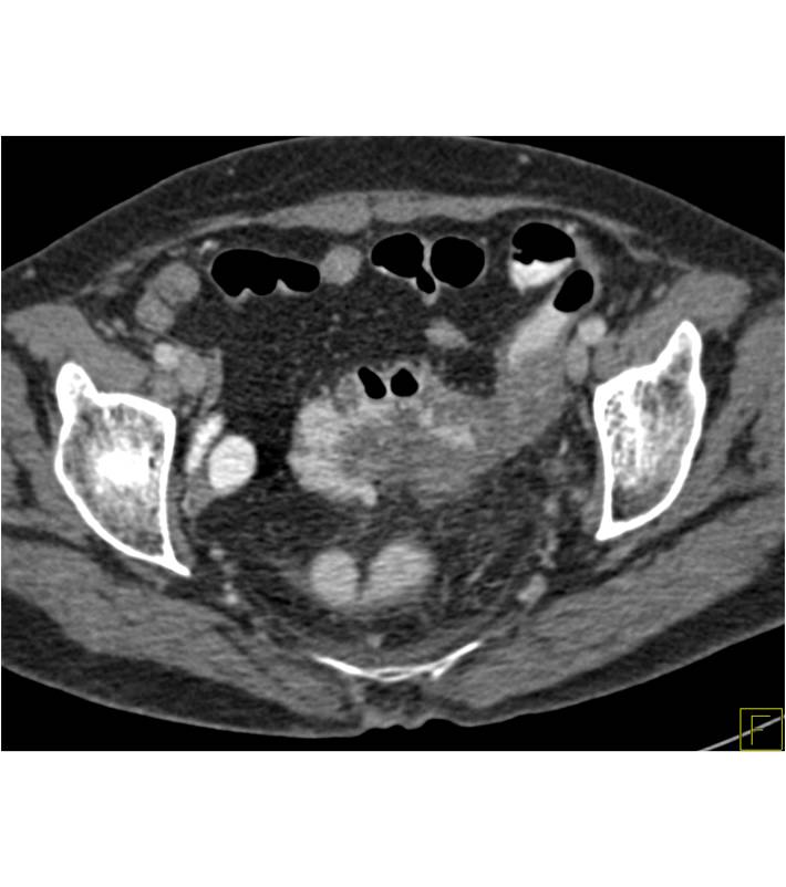 Diverticulitis with Fistulae to Dural Sac in Patient With Marfan and Dural Ectasia - CTisus CT Scan