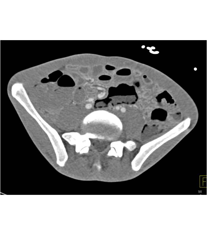 Pneumatosis Colon with Ischemic Bowel - CTisus CT Scan