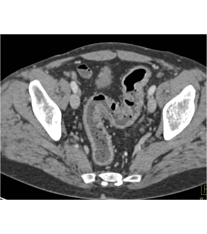 Ulcerative Colitis - Colon Case Studies - CTisus CT Scanning