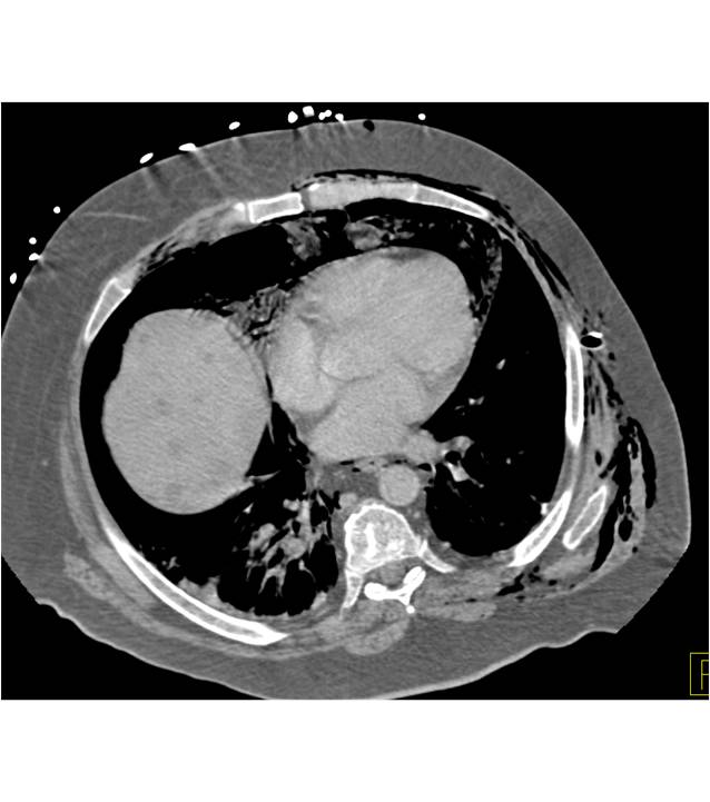 Pneumoperitonem due to Colonic Perforation - CTisus CT Scan