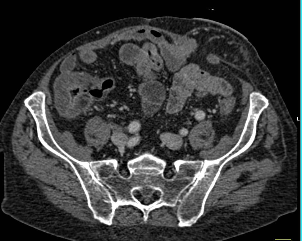 Pancolitis of Right Colon and Transverse Colon - CTisus CT Scan