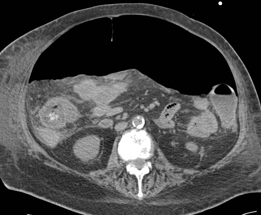 Pneumoperitoneum - CTisus CT Scan