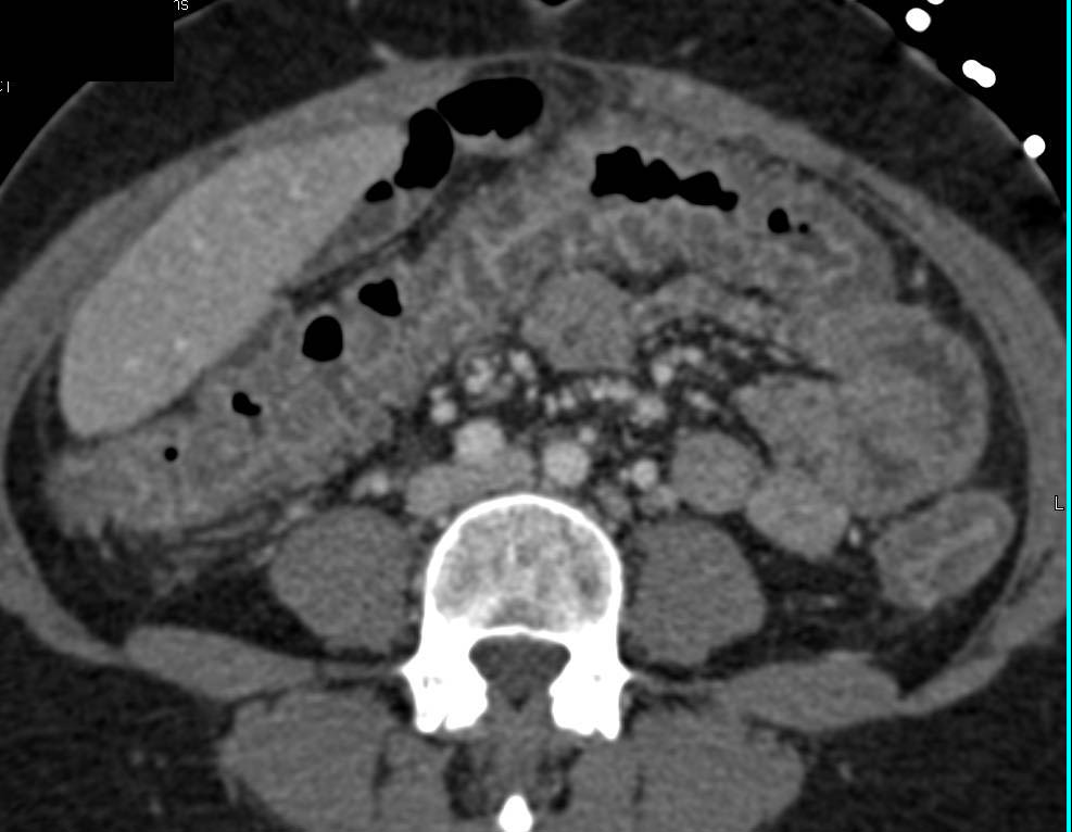 Pseudomembranous Colitis (PMC) - CTisus CT Scan