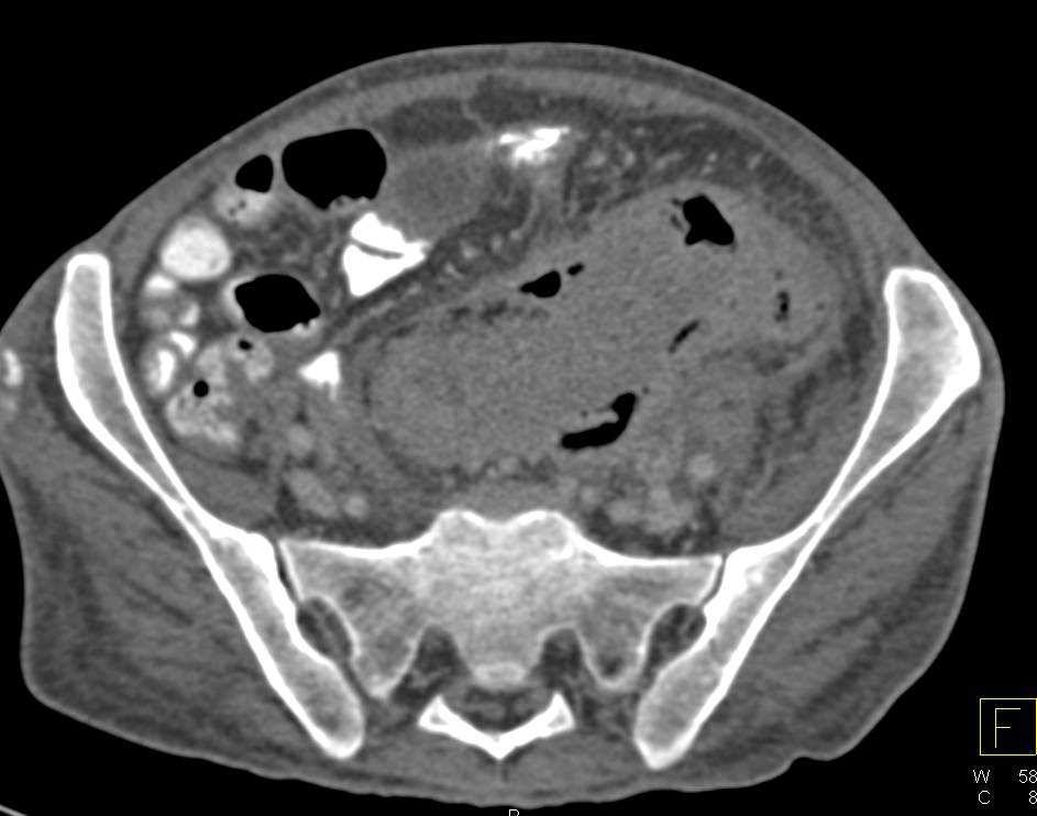 Obstructing Colon Cancer - CTisus CT Scan