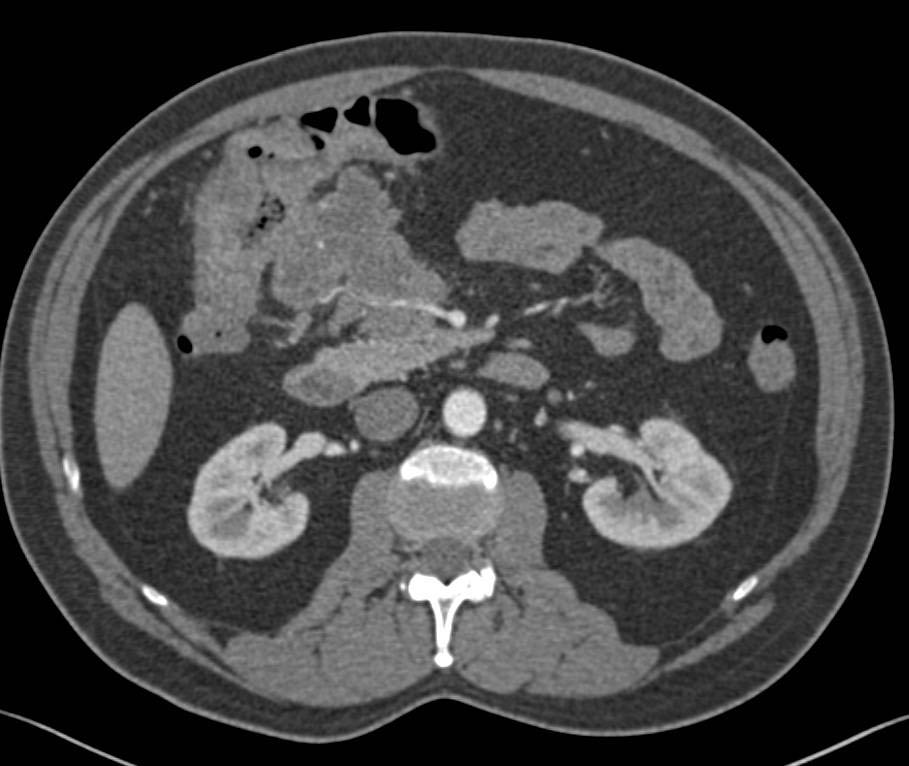 Incredible Case of Carcinoma of the Hepatic Flexure with Spread to Duodenum and Mesenteric Vessels Looking a Bit Like a Carcinoid Tumor - CTisus CT Scan
