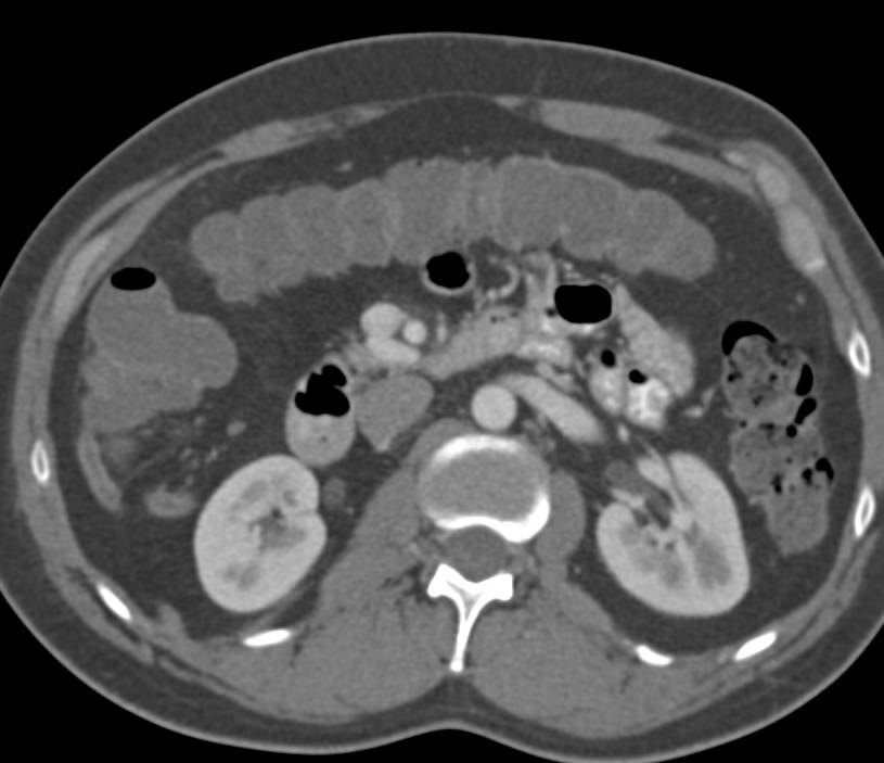 Early Appendicitis - CTisus CT Scan