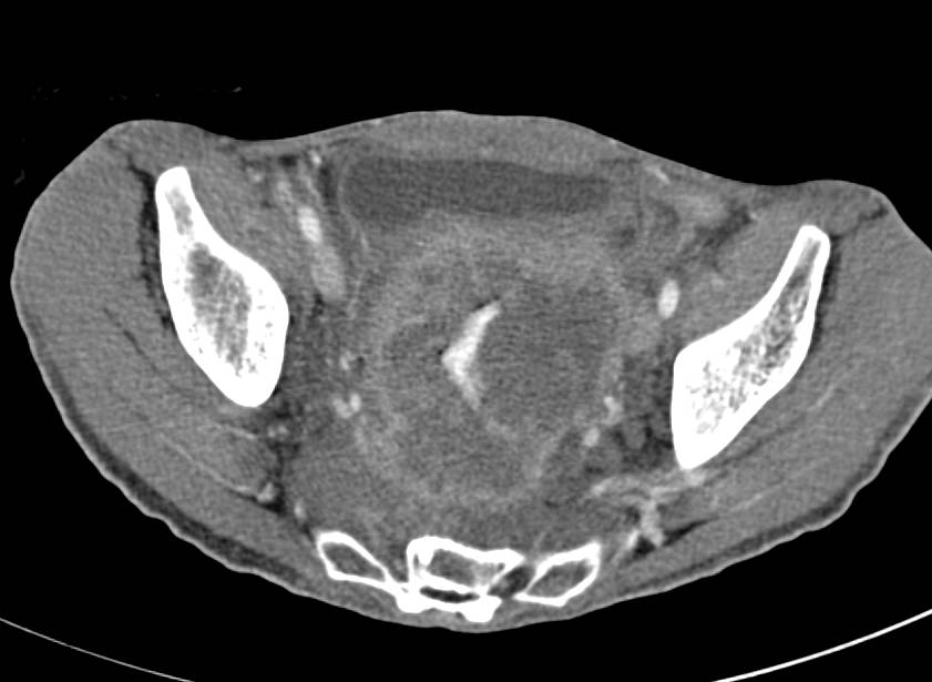 Bulky Rectal Cancer - CTisus CT Scan