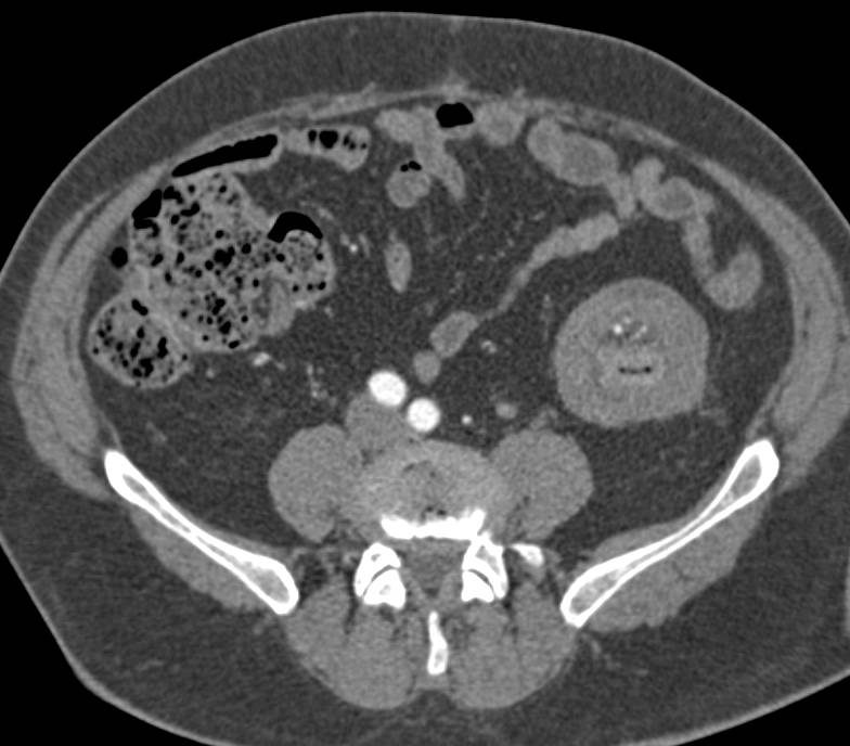 Carcinoma of the Descending Colon with Intussusception as well as Liver Metastases - CTisus CT Scan