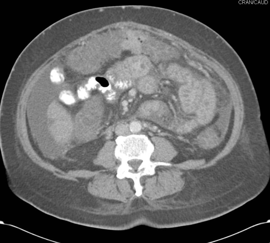 Pseudomembranous Colitis - CTisus CT Scan