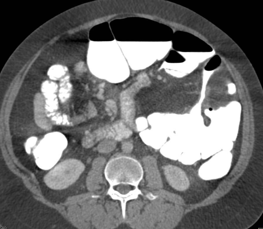 Cecal Volvulus - CTisus CT Scan