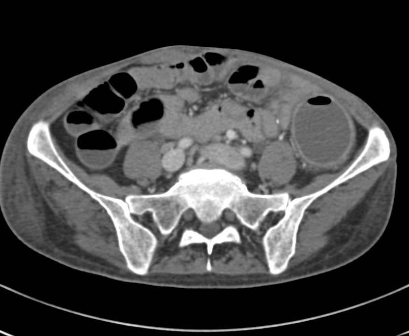 Ulcerative Colitis - CTisus CT Scan