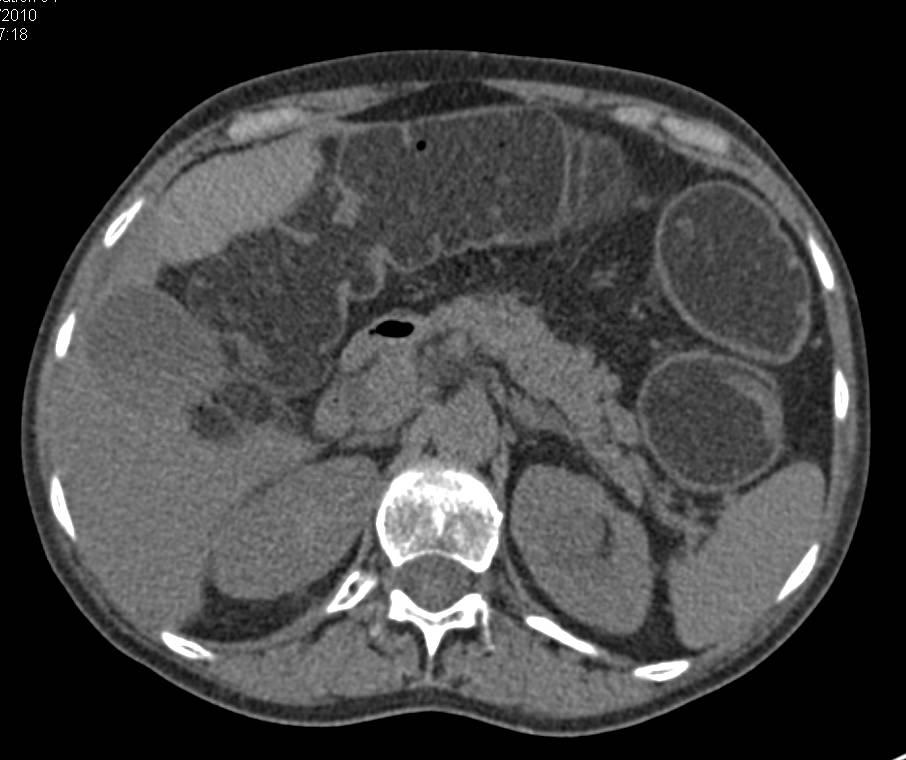 Fluid in Colon is Fat Density. The Patient was on a New Diet Drug That Blocked Fat Absorption - CTisus CT Scan