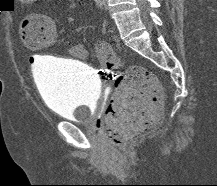 Colo-Vaginal Fistulae - CTisus CT Scan