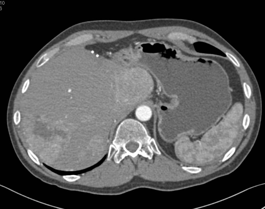 Recurrent Colon Cancer with Tumor in right Lower Quadrant Extending up to Right Kidney with Liver Metastases - CTisus CT Scan