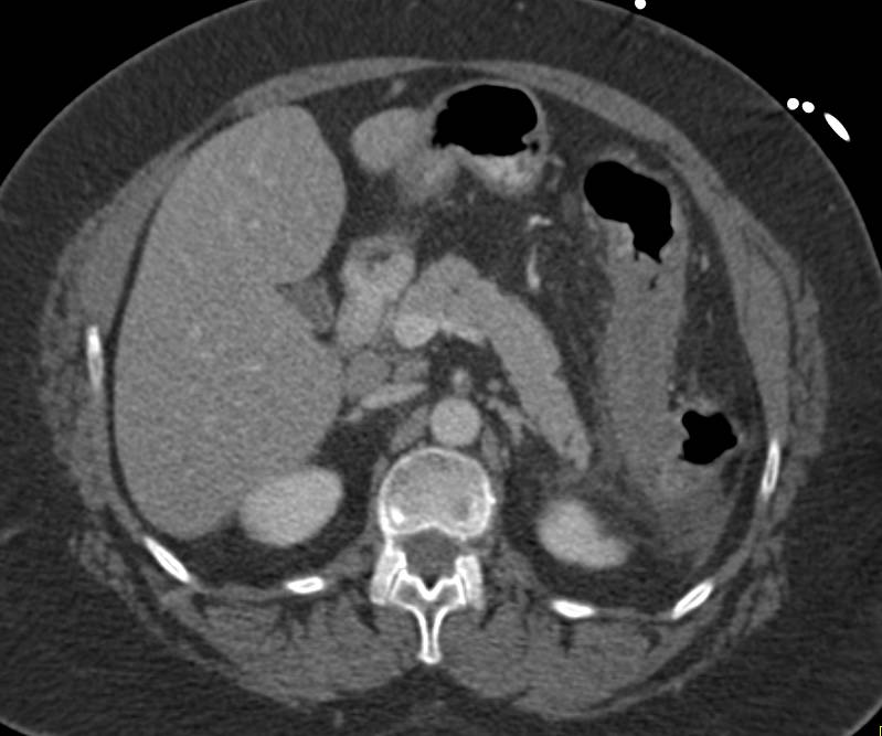 Ischemic Colitis Involves the Splenic Flexure - CTisus CT Scan