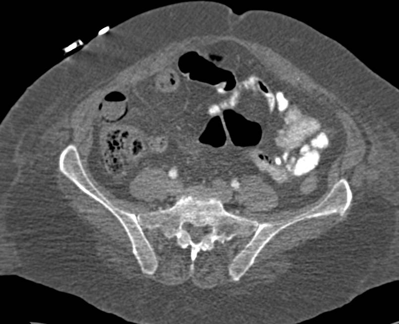 Difficulty at Times in Distinguishing Pneumatosis from Stool with Air in Bowel - CTisus CT Scan